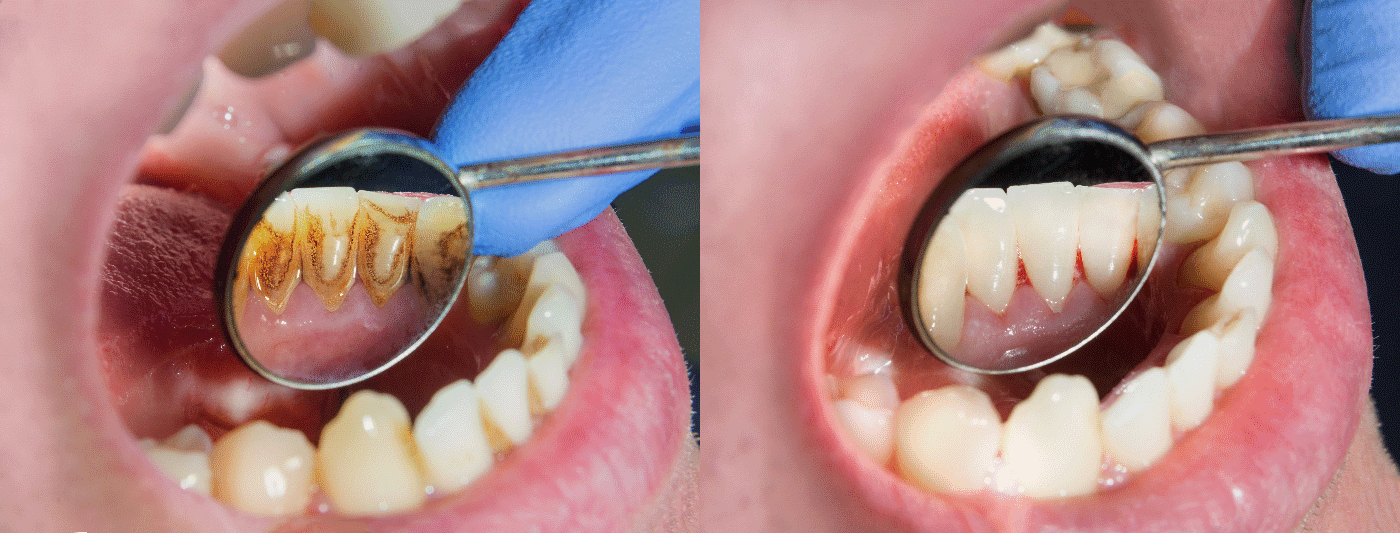 Zahnarzt Dübendorf Dentalhygiene